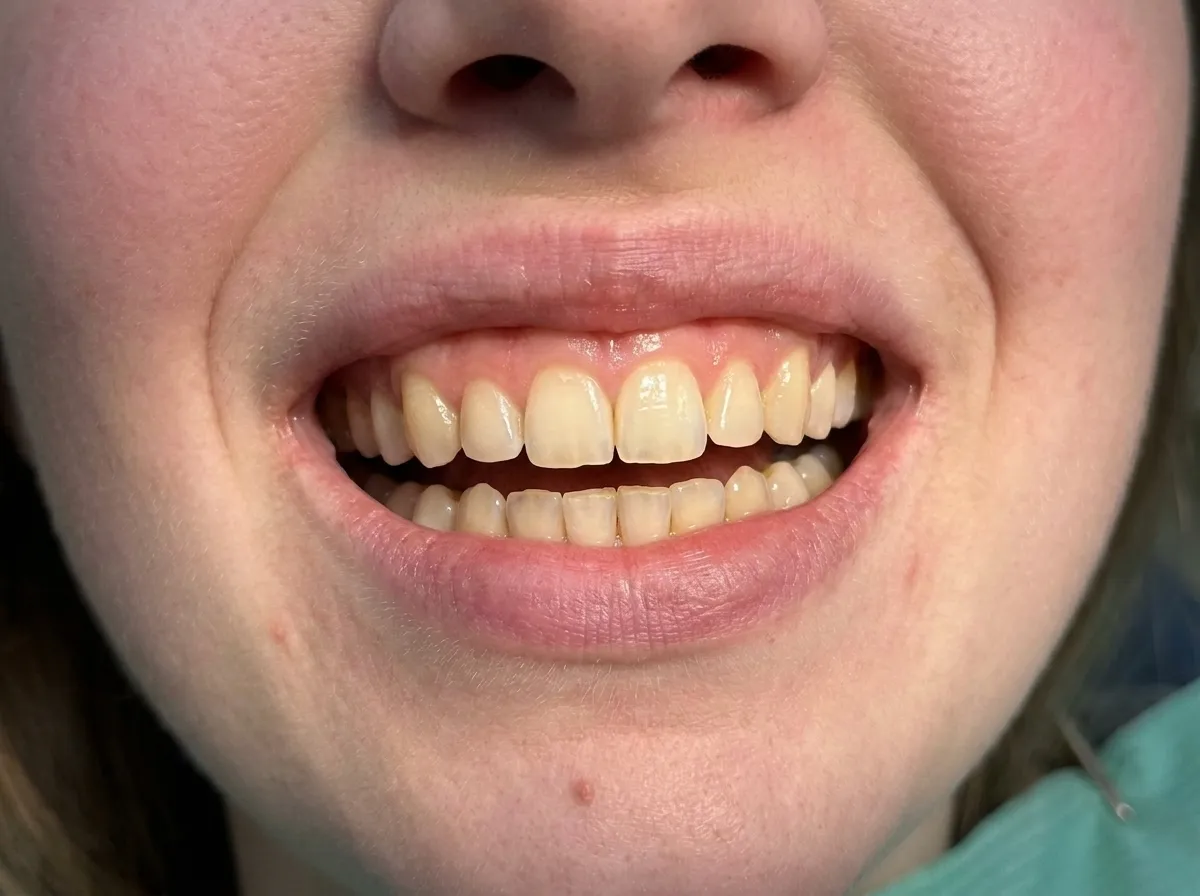 A chipped front tooth, smoothed and restored, after treatment